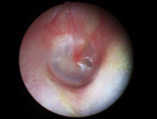 Perforasi Membran Timpani - patofisiologi, diagnosis, penatalaksanaan -  Alomedika