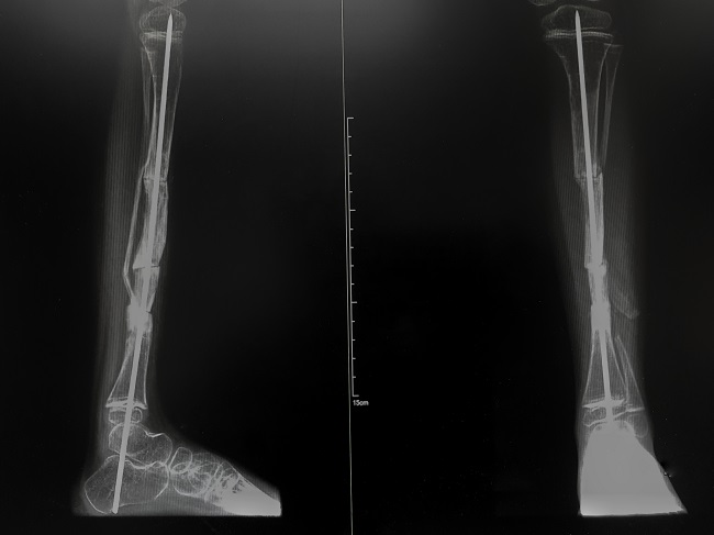 Osteogenesis Imperfecta - Alodokter