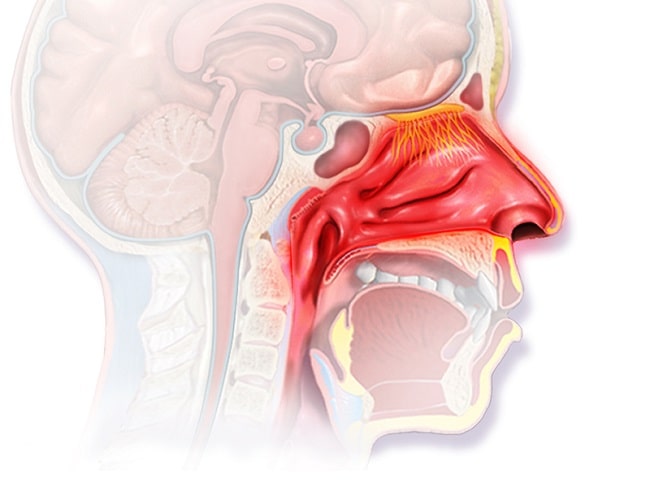 Bilateral Rhinitis Diagnosis Rhinitis Kronik - Alomedika