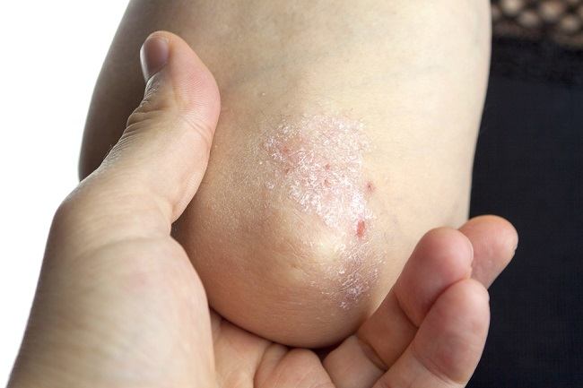 Cara Mengobati Psoriasis di Rumah - Alodokter