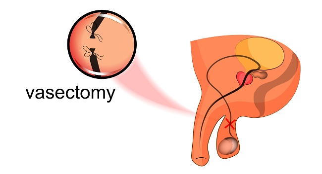 Jual Vasectomy Klem Vasektomi 14cm Premium Quality - Jakarta Barat - King  Medical