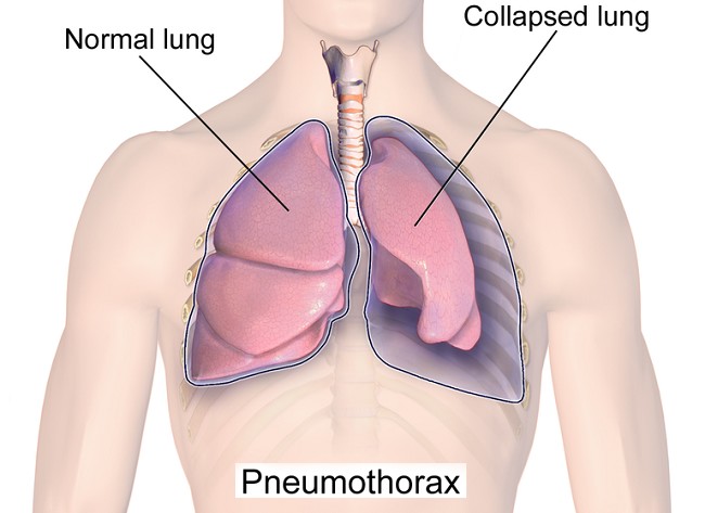 Pneumothorax - patofisiologi, diagnosis, penatalaksanaan - Alomedika