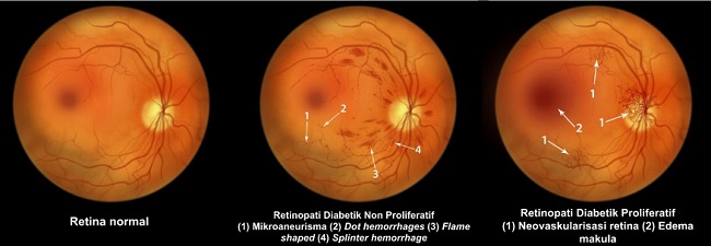 Skrining Retinopati Diabetik Kapan Dan Bagaimana Alomedika