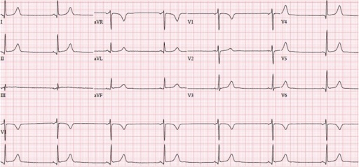 Sinus bradikardia 42 x/mnt. Sumber: anonim, Openi, 2015.