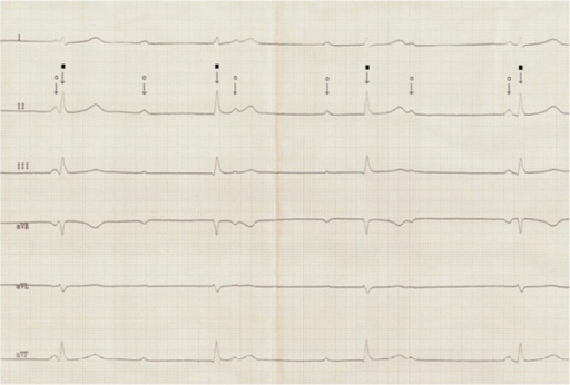 Ventricular escape rhythm. Sumber: anonim, Openi, 2013.