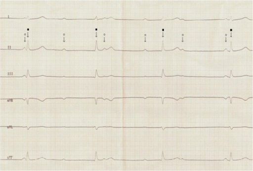 Ventricular escape rhythm. Sumber: anonim, Openi, 2013.