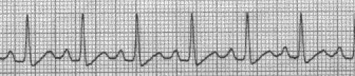 Sinus takikardia. Sumber: anonim, Openi, 2009.