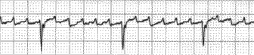 Atrial flutter. Sumber: anonim, Openi, 2009.