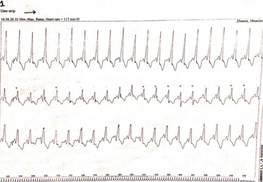 Sindrom Wolff-Parkinson-White. Sumber: anonim, Openi, 2014.