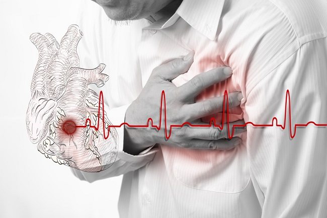 Angina Pektoris - patofisiologi, diagnosis, penatalaksanaan - Alomedika