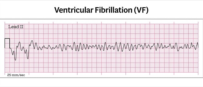 Gambar 1. Gambaran EKG VT polimorfik (Sumber : Openi, 2016)