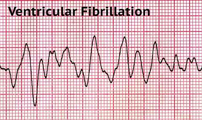 Diagnosis Fibrilasi Ventrikel - Alomedika