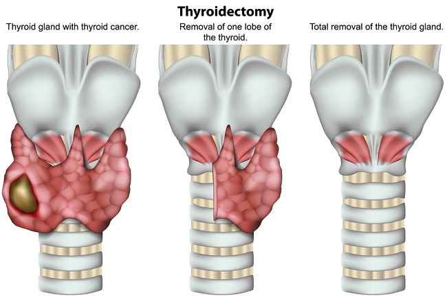 Untung Rugi Operasi Transoral Endoscopic Thyroidectomy Via Vestibular tsh-and-so-called-normal-tsh-levels-a-non-sciency-guide