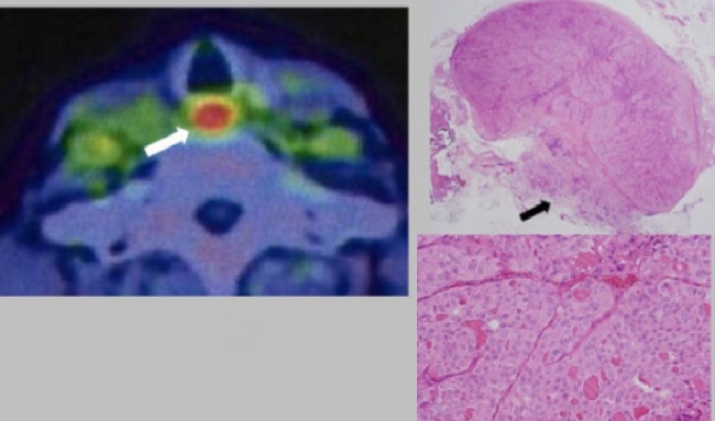 Kanker Tiroid Patofisiologi Diagnosis Penatalaksanaan Alomedika