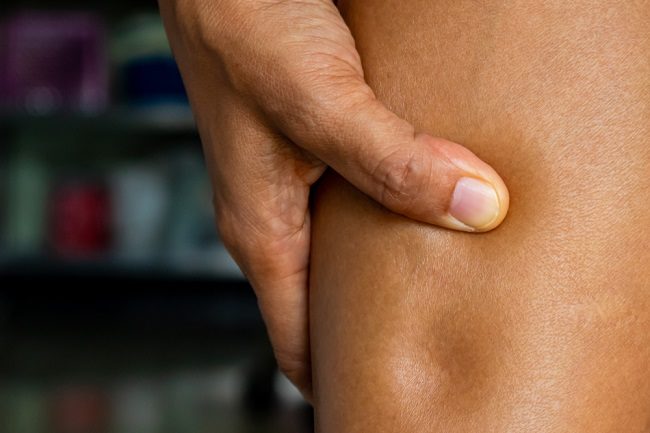 Pitting Edema, Ketahui Penyebab dan Cara Mengatasinya - Alodokter