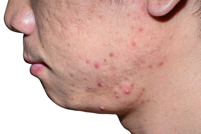 Membedakan Acne Vulgaris Dengan Fungal Acne Alomedika