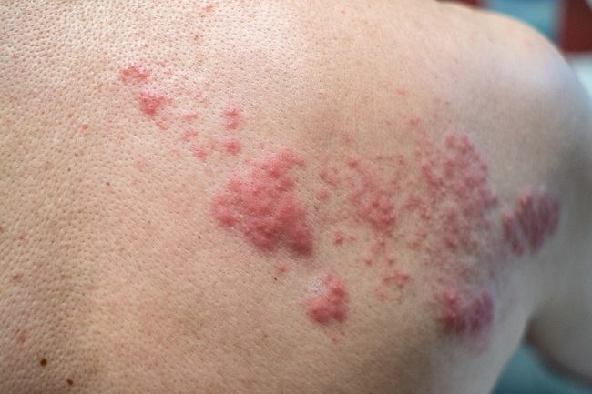 10 Obat Herpes Alami untuk Redakan Gejalanya - Alodokter