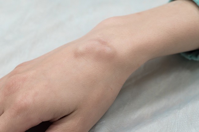 Xanthoma, Benjolan Lemak yang Muncul di Kulit - Alodokter