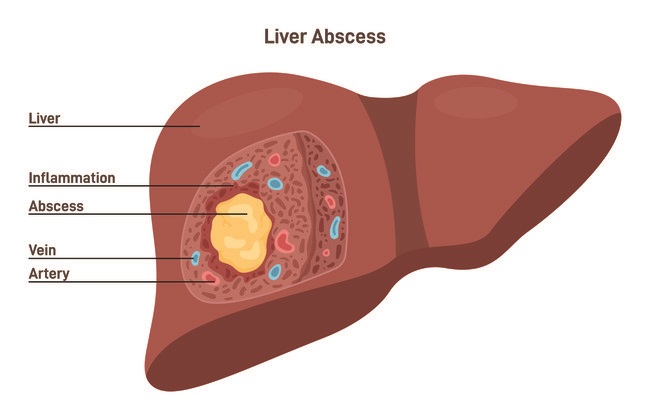 Abses Hati - Alodokter