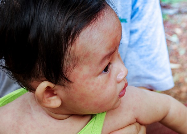 โรคหัด (Measles)