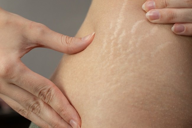 7 Cara Menghilangkan Stretch Mark secara Alami - Alodokter