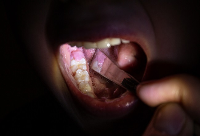 Perikoronitis - Gejala, Penyebab, dan Pengobatan - Alodokter