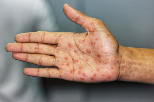 ซิฟิลิส (Syphilis) - อาการ, สาเหตุ, การรักษา - พบแพทย์ ซิฟิลิส (Syphilis) - อาการ, สาเหตุ, การรักษา - พบแพทย์