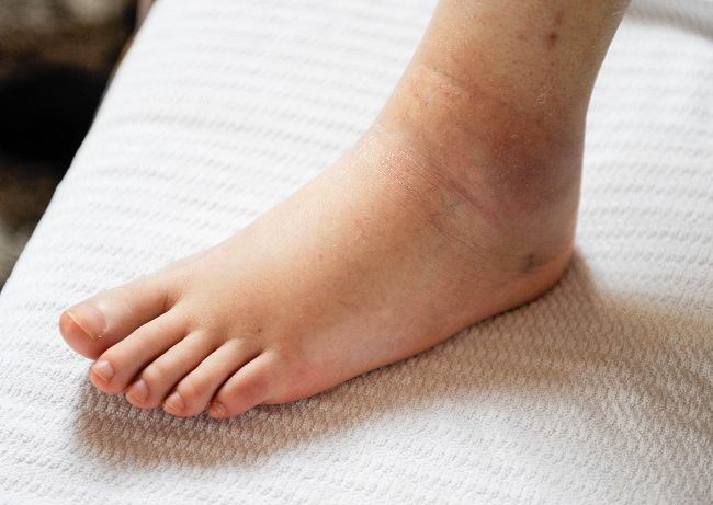 7 Effective Swollen Feet Medications