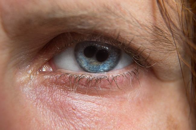 Polycoria, A Rare Condition When One Eye Has Two Pupils