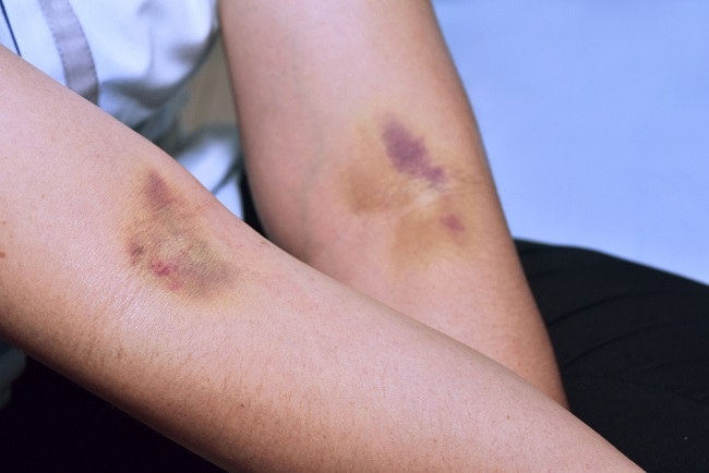 purpura-kenali-penyebab-gejala-dan-pengobatannya-alodokter