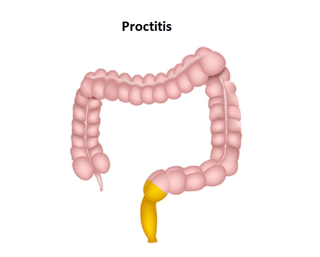 Diagnosis Proktitis - Alomedika
