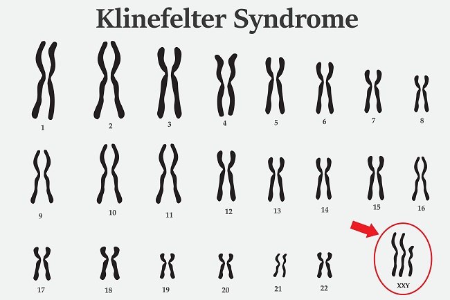 Ciri-Ciri Sindrom Klinefelter yang Harus Dikenali - Alodokter