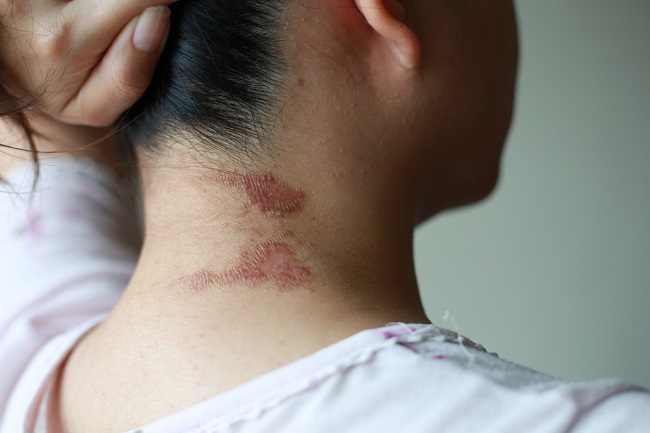 Dermatitis Venenata, Penyakit Kulit Akibat Sentuhan Tomcat - Alodokter