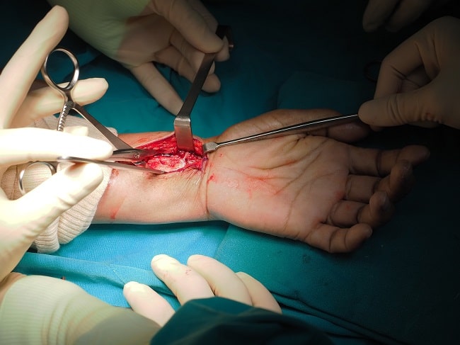 Surgical Plating VS Reduksi Tertutup dalam Penatalaksanaan Fraktur Radius Distal Lansia-min