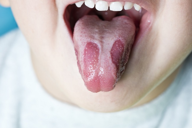 Geographic Tongue, Radang Lidah yang Menyerupai Peta - Alodokter