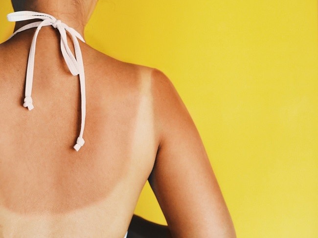 7 Cara Mengatasi Kulit Belang yang Efektif - Alodokter