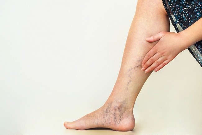 7 Effective Ways to Treat Varicose Veins