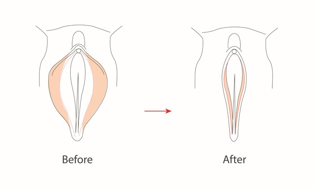 Labiaplasty dan Hal-hal Penting di Dalamnya - Alodokter