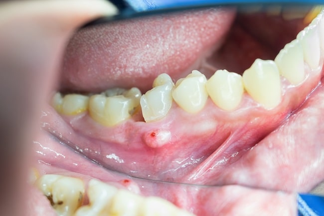 Abses Periapikal Patofisiologi Diagnosis Penatalaksanaan Alomedika