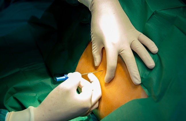 Ropivacaine-Alodokter