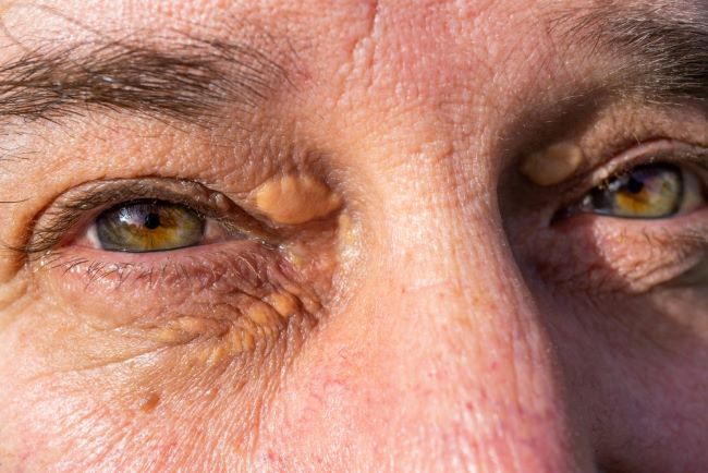 Xanthelasma, Ketahui Penyebab dan Cara Mengatasinya - Alodokter