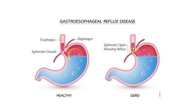 GERD - Alodokter