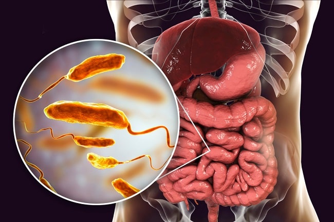 Kolera - patofisiologi, diagnosis, penatalaksanaan - Alomedika