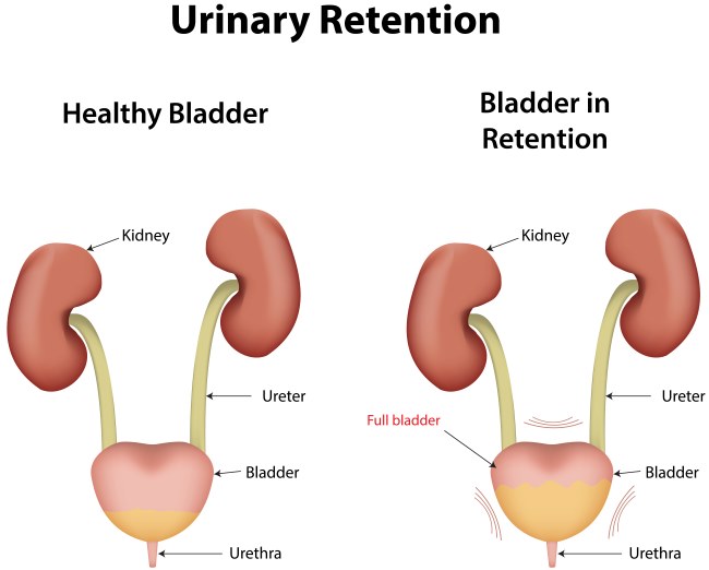 Retensi Urine