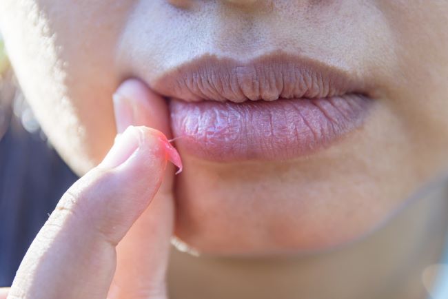 8 Penyebab Bibir Kering yang Sering Terjadi Tanpa Disadari - Alodokter