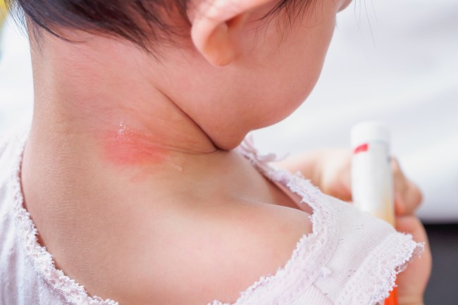 Leher Bayi Merah, Ketahui Penyebab dan Penanganannya - Alodokter