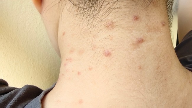 Acne on the Neck