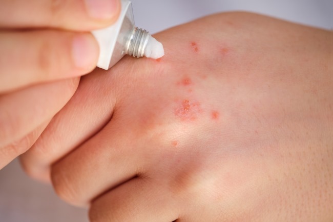 Hidrocortisone Topikal