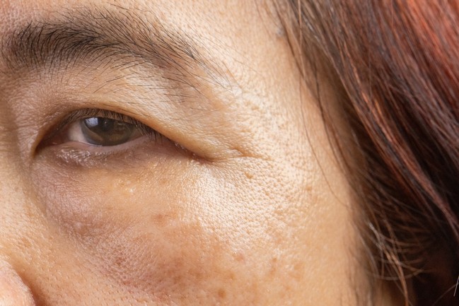 Droopy Eyelids