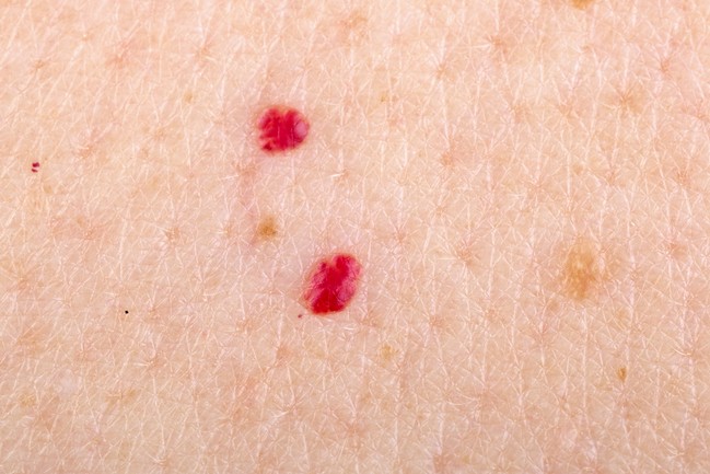 Red mole Cherry angiomas